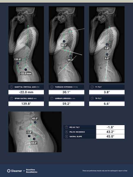 BoneMetrics Scoliosis with AI