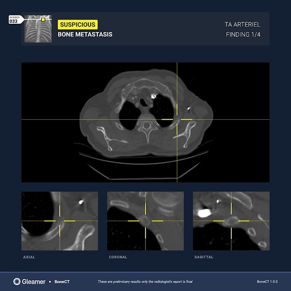 Suspicious bone metastasis