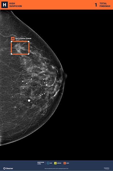 Gleamer findings x-ray