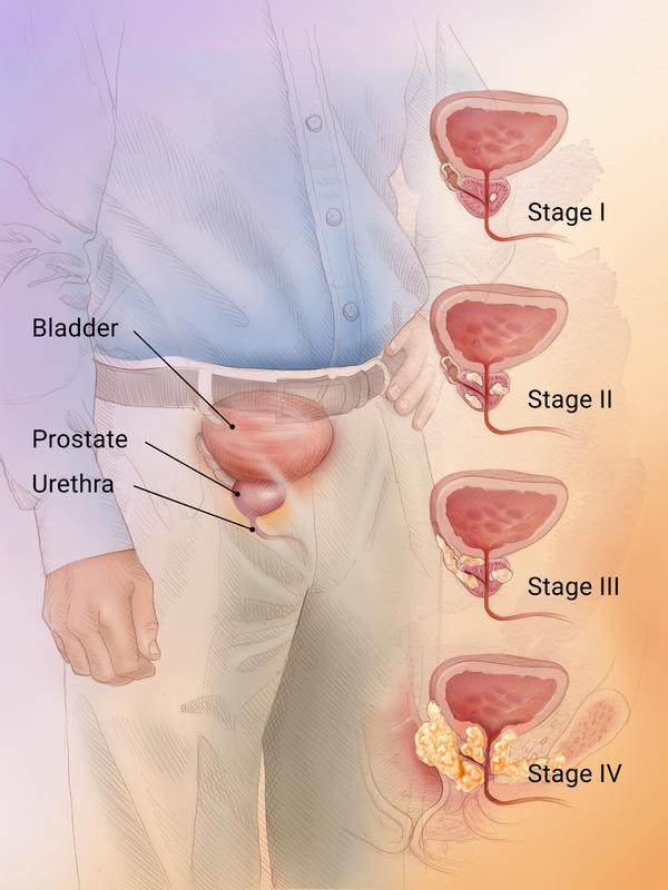 A series of close-ups showing prostate cancer progression from Stage 1 to Stage 4.
