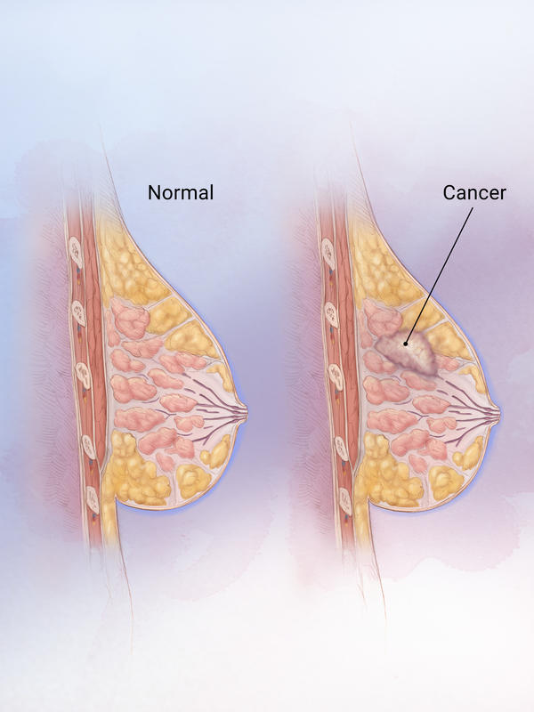Close-up of cancer in the breast tissue.