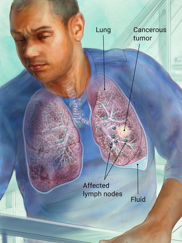 Man with lungs outlined to show the tumor, fluid, and affected lymph nodes.