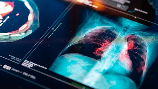 A photograph of a digital radiology interface displaying lung scans with AI-enhanced highlights, used to illustrate the Apollo Radiology International case study. The image demonstrates how AI technology assists radiologists in identifying critical findings more quickly and accurately to improve patient outcomes in large-scale screening programs.