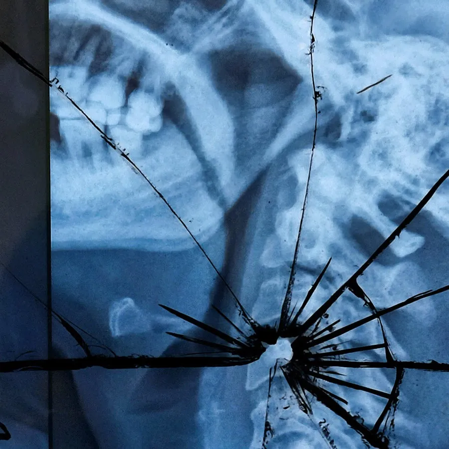 An x-ray image of a neck and head injury with a cracked glass effected overlaid on the image.